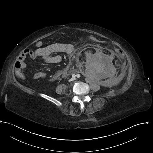 File:Active renal extravasation with large subcapsular and retroperitoneal hemorrhage (Radiopaedia 60975-68796 Axial 226).jpg