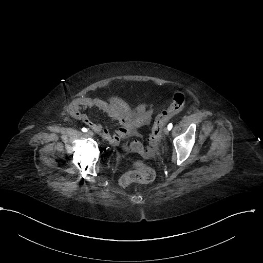 Active renal extravasation with large subcapsular and retroperitoneal hemorrhage (Radiopaedia 60975-68796 Axial C+ arterial phase 174).jpg