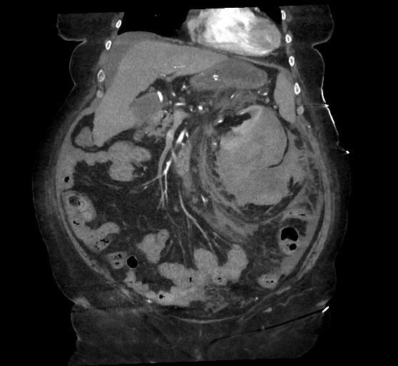 Active renal extravasation with large subcapsular and retroperitoneal hemorrhage (Radiopaedia 60975-68796 Coronal C+ arterial phase 59).jpg