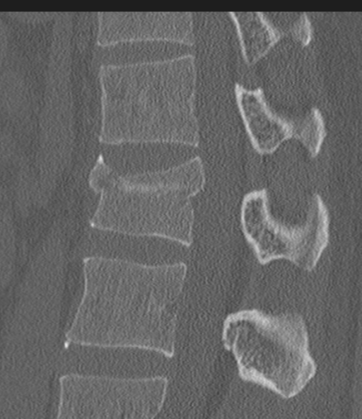 File:Acute L1 burst compression fracture (Radiopaedia 34430-35755 Sagittal bone window 35).png