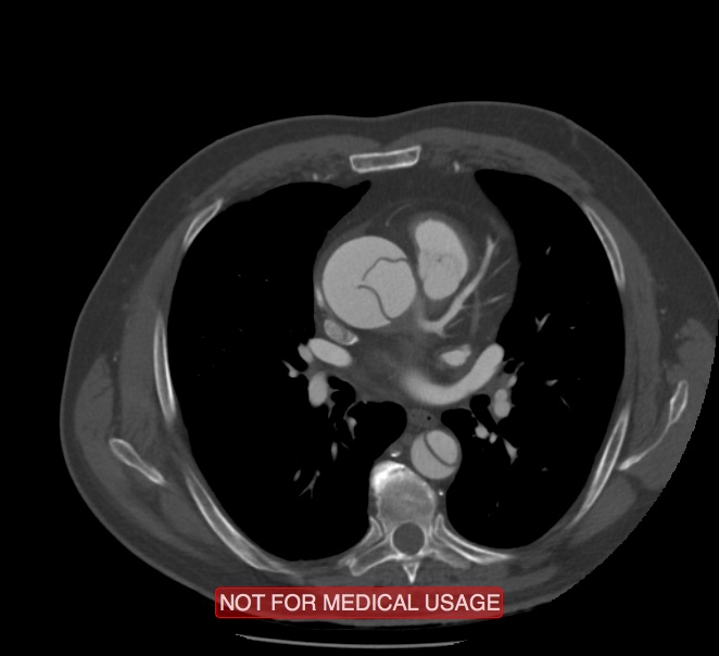 Acute aortic dissection - Stanford type A (Radiopaedia 40661-43285 Axial C+ arterial phase 31).jpg