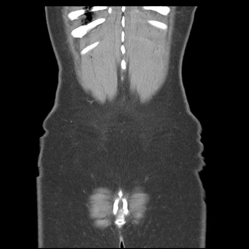 Acute appendicitis (Radiopaedia 30297-30934 Coronal C+ portal venous phase 45).jpg