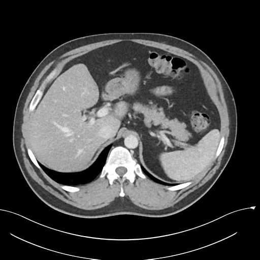 Acute appendicitis (Radiopaedia 36611-38177 Axial C+ portal venous phase 26).png