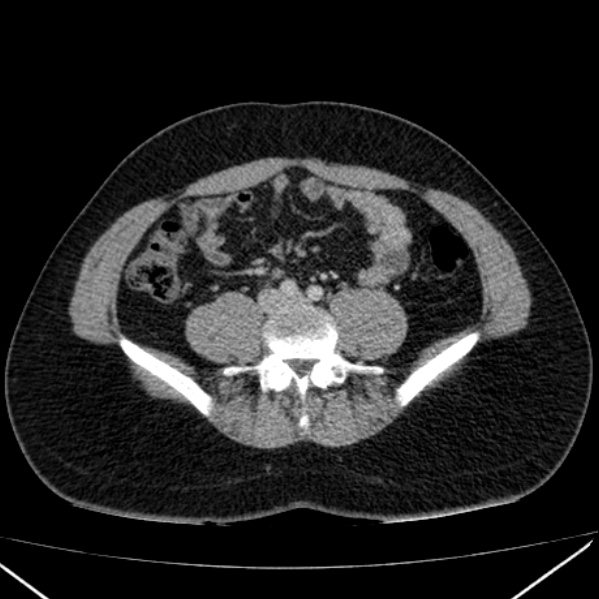 Acute appendicitis (Radiopaedia 38255-40270 Axial C+ portal venous phase 68).jpg