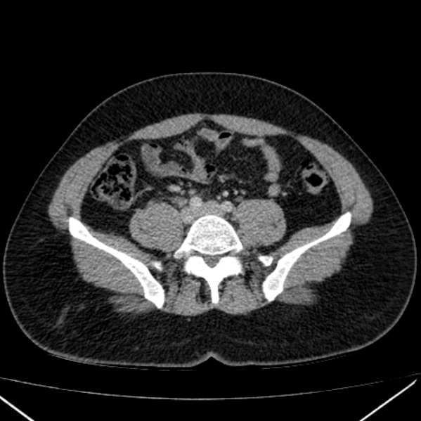 Acute appendicitis (Radiopaedia 38255-40270 Axial C+ portal venous phase 72).jpg