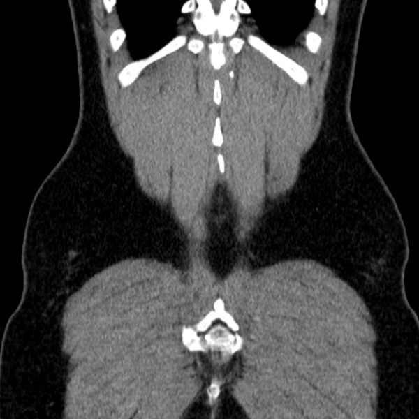 File:Acute appendicitis (Radiopaedia 38255-40270 Coronal C+ portal venous phase 79).jpg