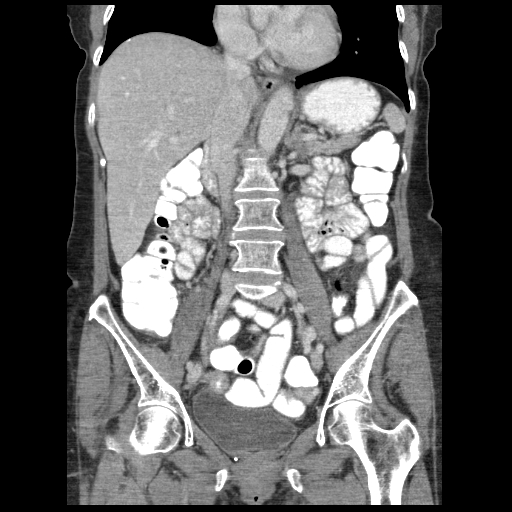 File:Acute appendicitis (Radiopaedia 52672-58589 Coronal C+ portal venous phase 58).jpg