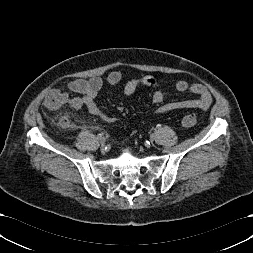 File:Acute appendicitis (Radiopaedia 58627-65818 Axial non-contrast 65).jpg