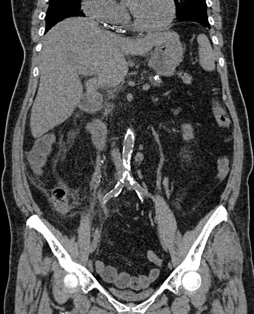 Acute appendicitis (Radiopaedia 58627-65818 Coronal non-contrast 39).jpg