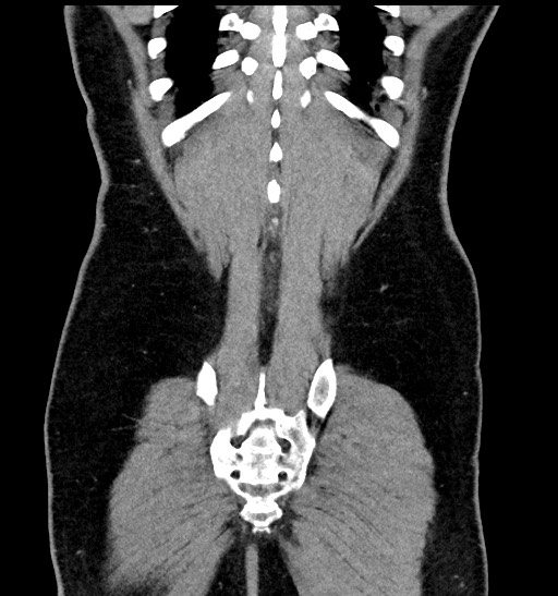 Acute appendicitis (Radiopaedia 77016-88960 Coronal C+ portal venous phase 86).jpg