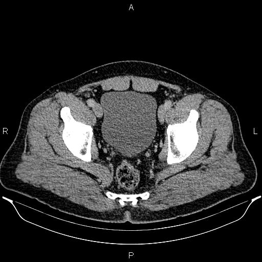 File:Acute appendicitis (Radiopaedia 84780-100240 Axial C+ portal venous phase 98).jpg