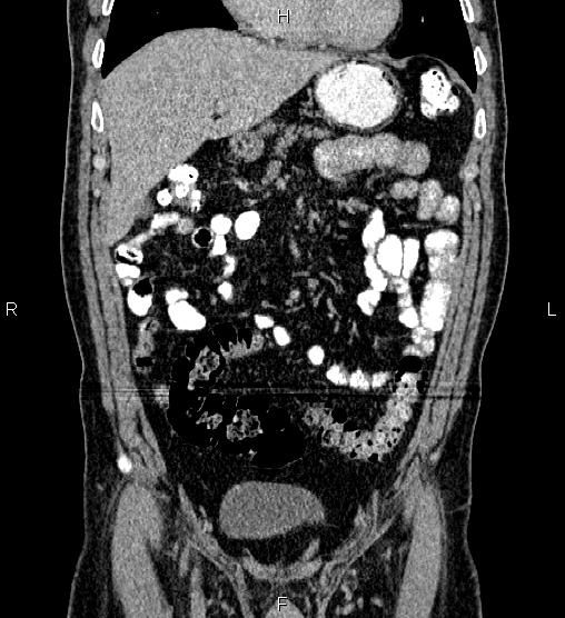 Acute appendicitis (Radiopaedia 84780-100240 Coronal C+ portal venous phase 25).jpg