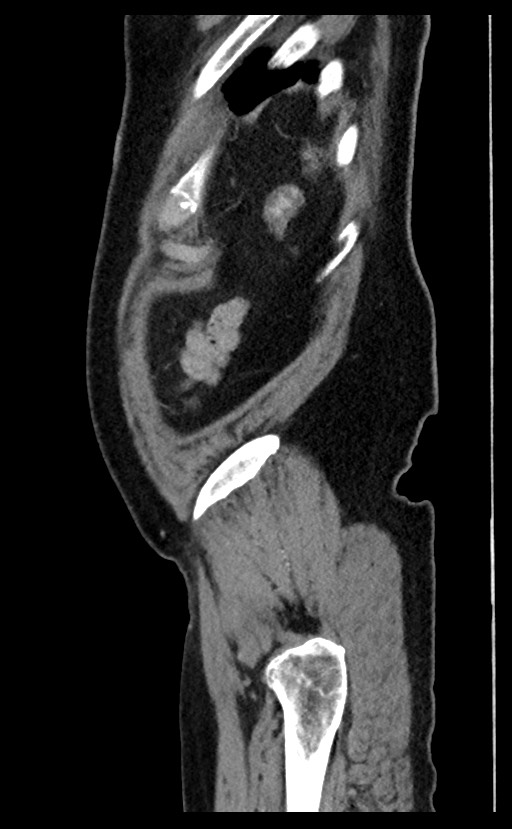 Acute appendicitis - large appendicoliths (Radiopaedia 61805-69820 Sagittal C+ portal venous phase 10).jpg