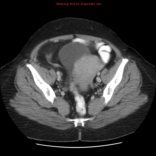 Acute appendicitis complicated by ovarian vein thrombophlebitis (Radiopaedia 16172-15851 Axial C+ portal venous phase 75).jpg