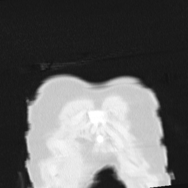Acute aspiration pneumonitis (Radiopaedia 33605-34703 Coronal lung window 7).jpg