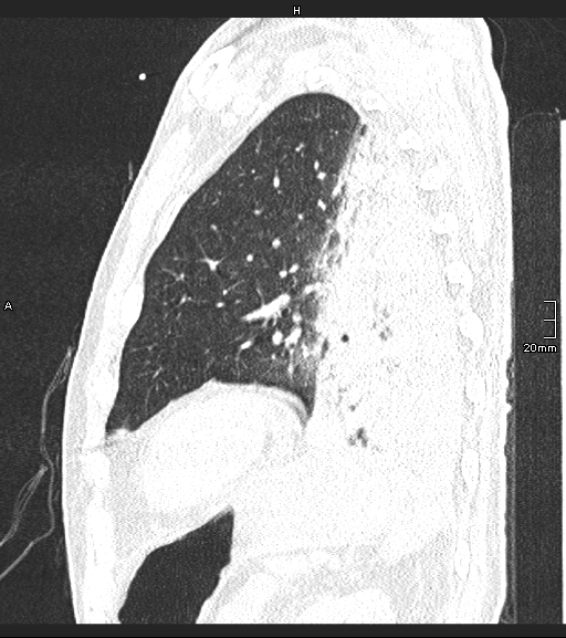 Acute aspiration pneumonitis (Radiopaedia 55642-62166 Sagittal lung window 33).jpg