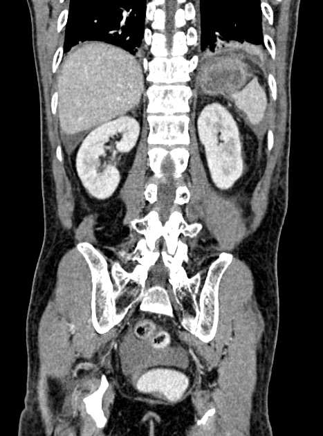 Acute bowel ischemia (Radiopaedia 87695-104114 Coronal C+ portal venous phase 284).jpg