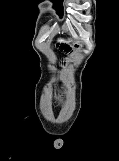 Acute bowel ischemia (Radiopaedia 87695-104114 Coronal C+ portal venous phase 73).jpg