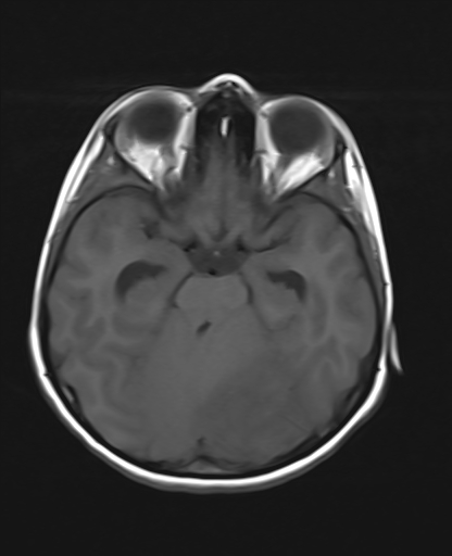 File:Acute cerebellar ataxia (Radiopaedia 61487-69446 Axial T1 8).jpg