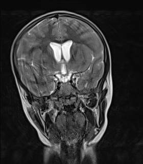 File:Acute cerebellar ataxia (Radiopaedia 61487-69446 Coronal T2 5).jpg