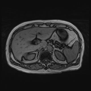File:Acute cholecystitis (Radiopaedia 72392-82923 Axial T1 out-of-phase 44).jpg