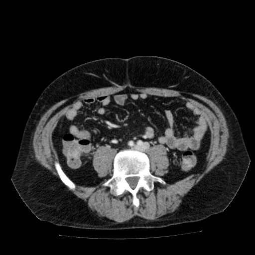 Acute cholecystitis and incidental left sided IVC (Radiopaedia 49352-54459 Axial C+ portal venous phase 96).jpg