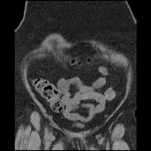 Acute cholecystitis and ureteric colic (Radiopaedia 42330-45444 Coronal prone 25).jpg