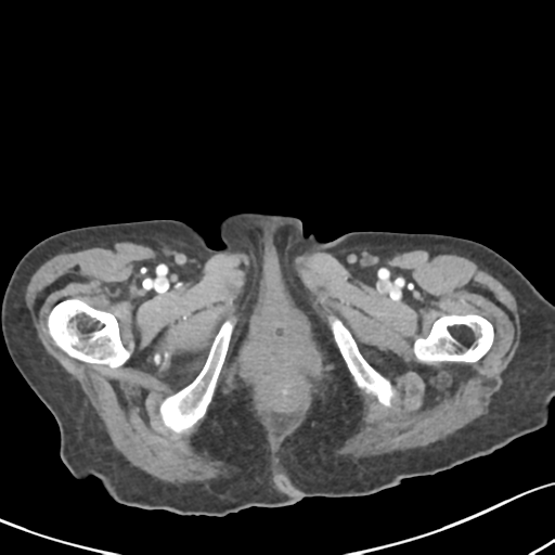 Acute cholecystitis with contained perforation (Radiopaedia 47328-51907 Axial C+ portal venous phase 80).png