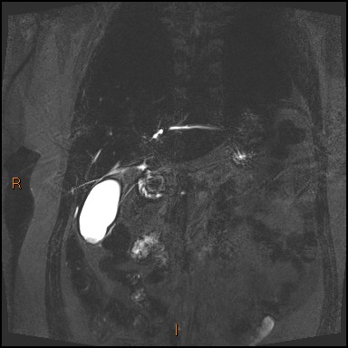 File:Acute cholecystitis with gallbladder neck calculus (Radiopaedia 42795-45971 Coronal Turbo spin echo 34).jpg