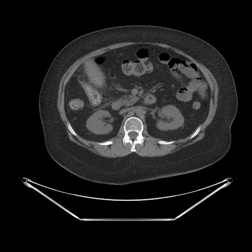 Acute cholecystitis with tensile fundus sign (Radiopaedia 71394-81723 Axial non-contrast 31).jpg
