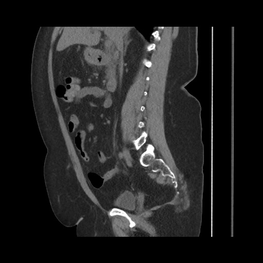 Acute cholecystitis with tensile fundus sign (Radiopaedia 71394-81723 Sagittal non-contrast 79).jpg