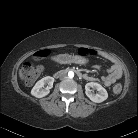 Acute colonic hemorrhage in ulcerative colitis (Radiopaedia 77415-89538 Axial C+ arterial phase 59).jpg