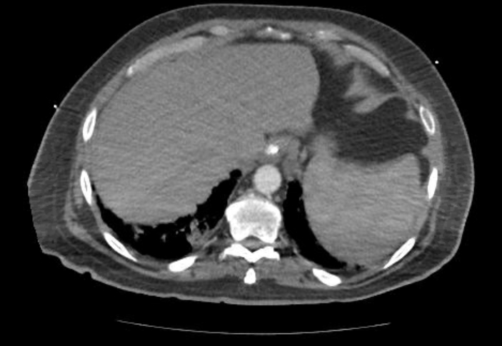 Acute cor pulmonale (ultrasound) (Radiopaedia 83508-98818 Axial C+ CTPA 72).jpg