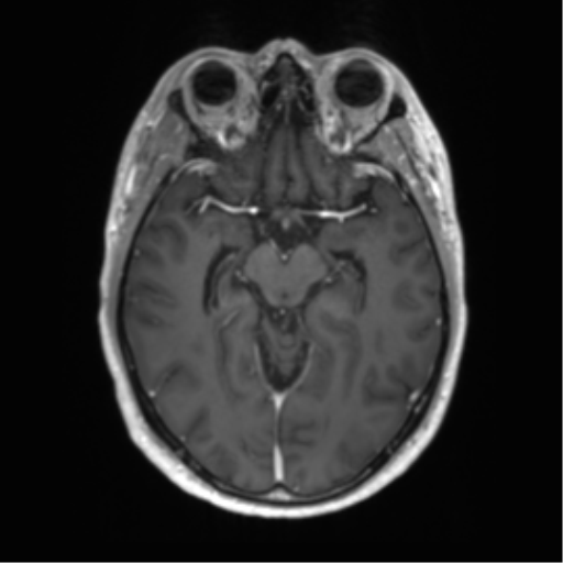Acute disseminated encephalomyelitis (ADEM) (Radiopaedia 65319-74350 Axial T1 C+ 23).png