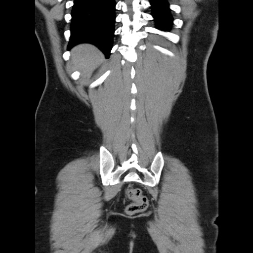 File:Acute diverticulitis with localized perforation (Radiopaedia 41296-44113 Coronal C+ portal venous phase 53).jpg