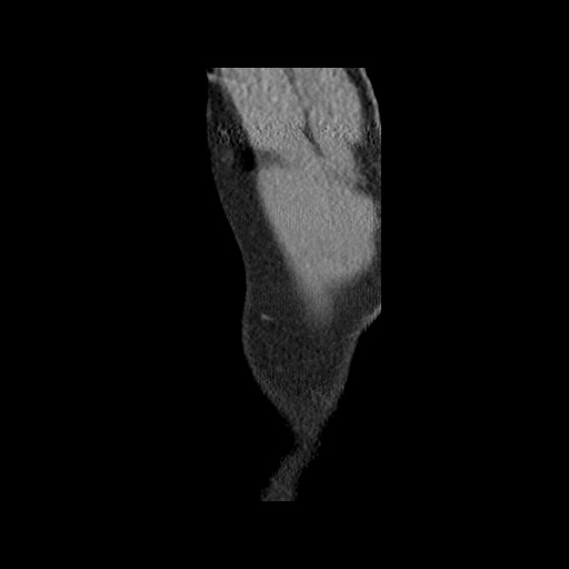 Acute epicardial fat necrosis (Radiopaedia 42327-45440 Sagittal C+ CTPA 3).jpg