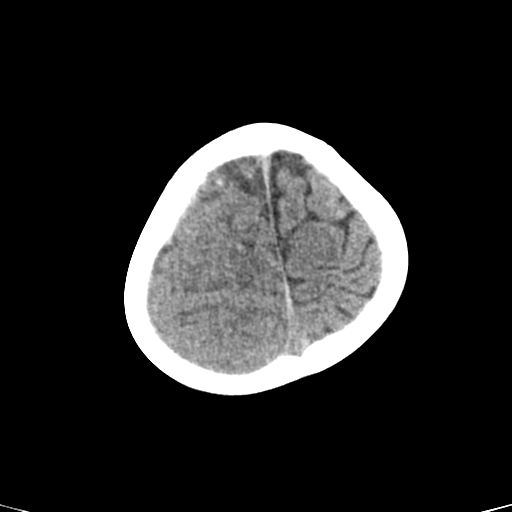 File:Acute hemorrhagic contusion (Radiopaedia 63660-72336 Axial non-contrast 38).jpg