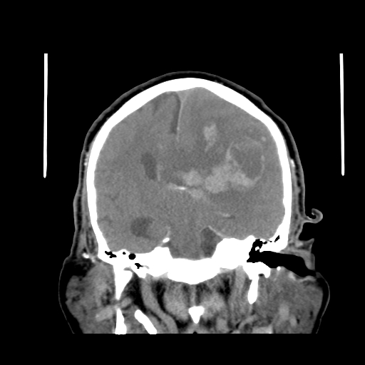 Acute hemorrhagic stroke (Radiopaedia 17507-17223 Coronal non-contrast 28).jpg