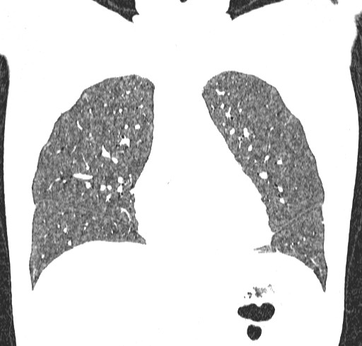 File:Acute hypersensitivity pneumonitis (Radiopaedia 85293-100870 Coronal lung window 40).jpg
