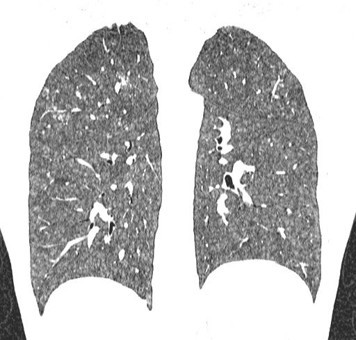 Acute hypersensitivity pneumonitis (Radiopaedia 85293-100870 Coronal lung window 92).jpg
