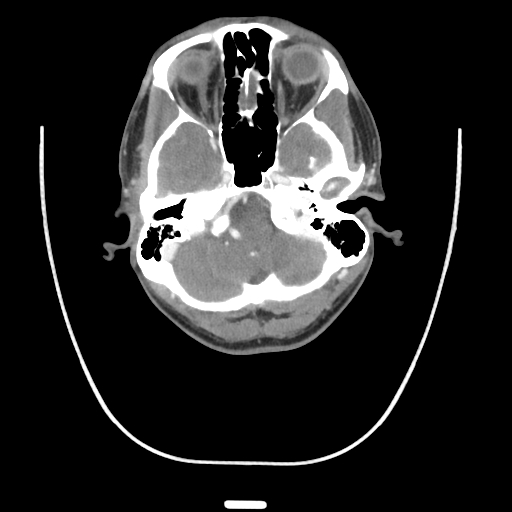 Acute longus colli calcific tendinitis (Radiopaedia 72495-83036 Axial C+ arterial phase 4).jpg