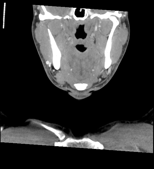 Acute longus colli calcific tendinitis (Radiopaedia 72495-83036 Coronal C+ arterial phase 18).jpg