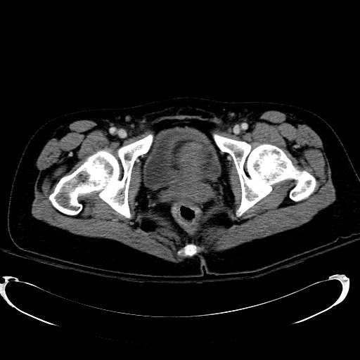 Acute myocardial infarction in CT (Radiopaedia 39947-42415 Axial C+ portal venous phase 131).jpg