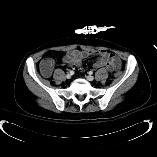 Acute myocardial infarction in CT (Radiopaedia 39947-42415 Axial C+ portal venous phase 93).jpg