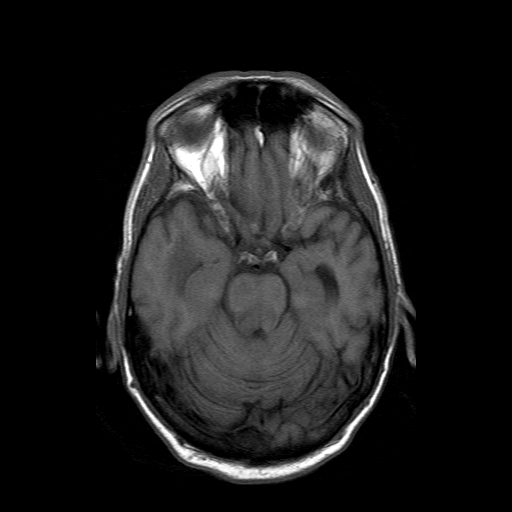File:Acute necrotizing toxoplasma encephalitis (Radiopaedia 10683-11149 Axial T1 12).jpg