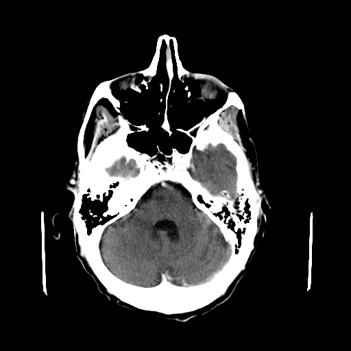 File:Acute necrotizing toxoplasma encephalitis (Radiopaedia 10683-11150 C+ arterial phase 24).jpg