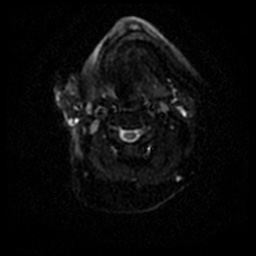 Acute otitis externa (Radiopaedia 57296-64236 Axial DWI 47).jpg