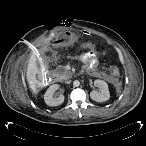 Acute pancreatic necrosis (Radiopaedia 13560-18503 Axial C+ portal venous phase 33).jpg