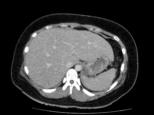 File:Acute pancreatitis (Radiopaedia 69236-79012 Axial C+ portal venous phase 20).jpg