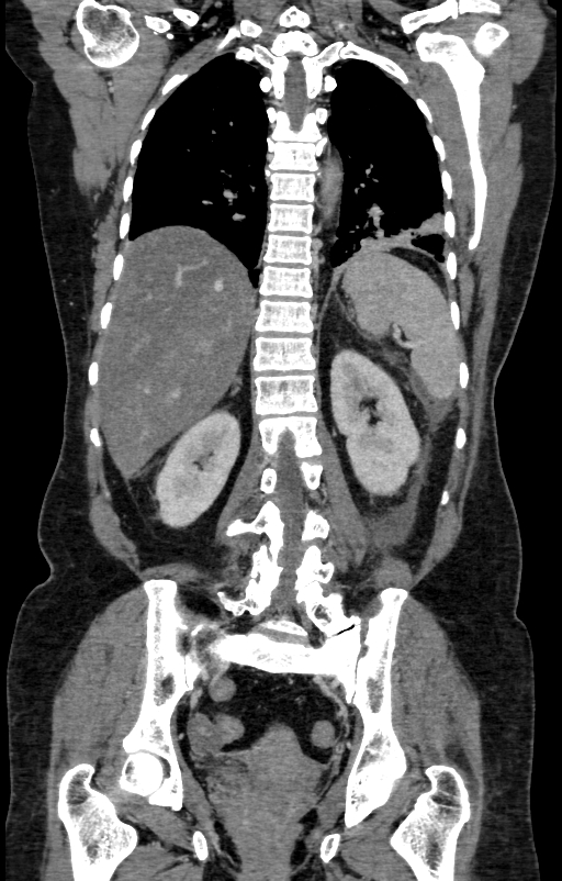 Acute pancreatitis (Radiopaedia 80007-93285 Coronal C+ portal venous phase 113).jpg